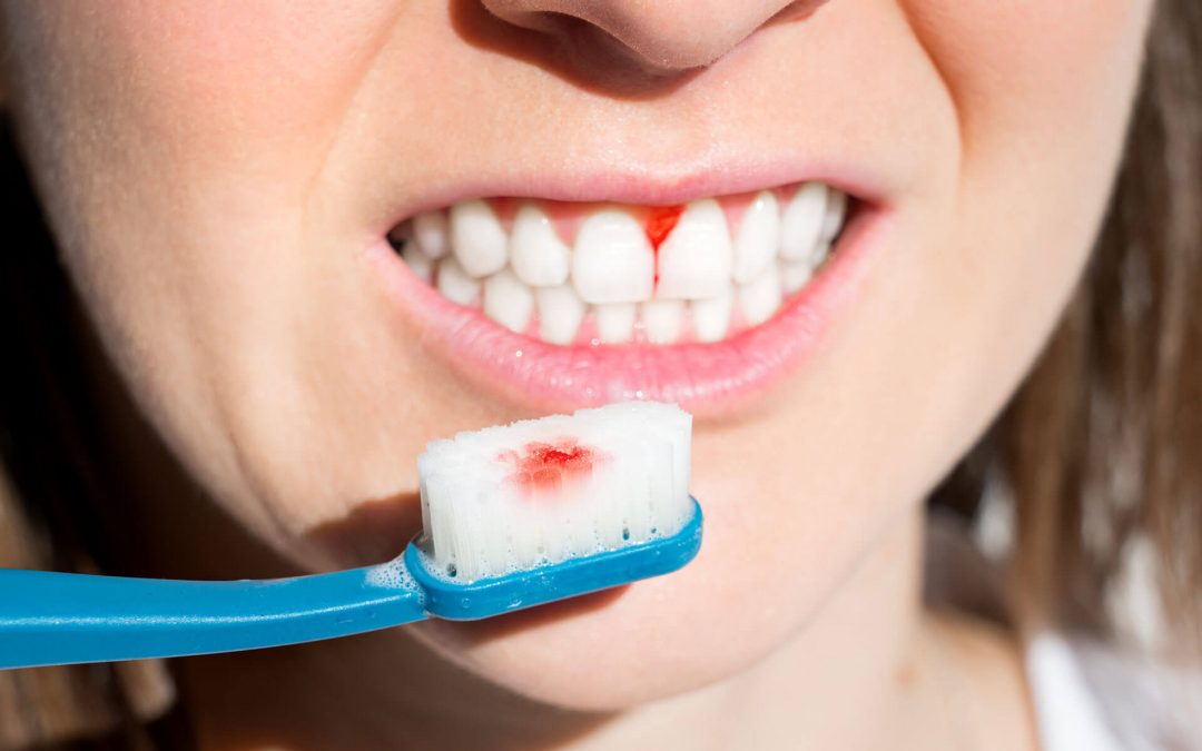 How to Stop Your Bleeding Gums?
