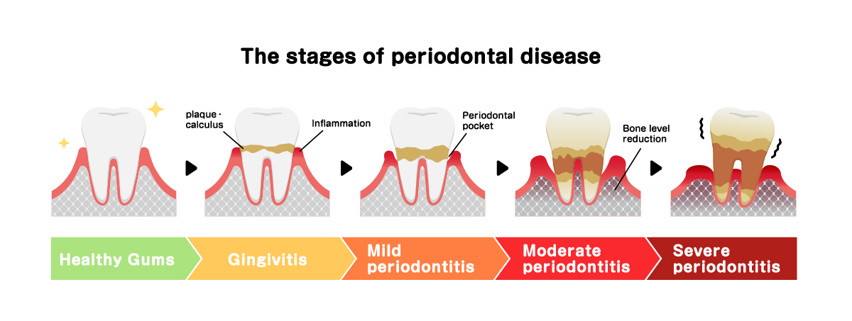 stages of periodontal disease
