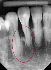 xray of teeth after using oral botanica