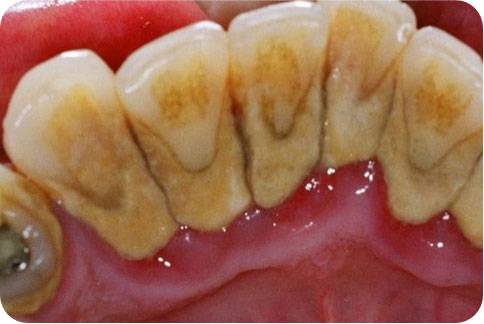 Calcified and discolored deposits of plaque from poor oral health