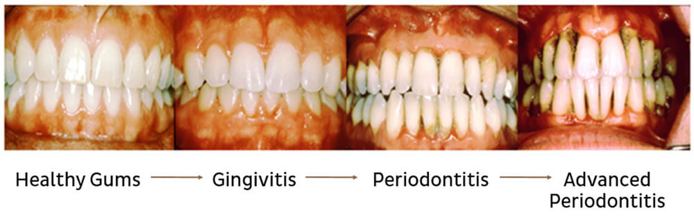 stages of receding gum disease from poor oral health