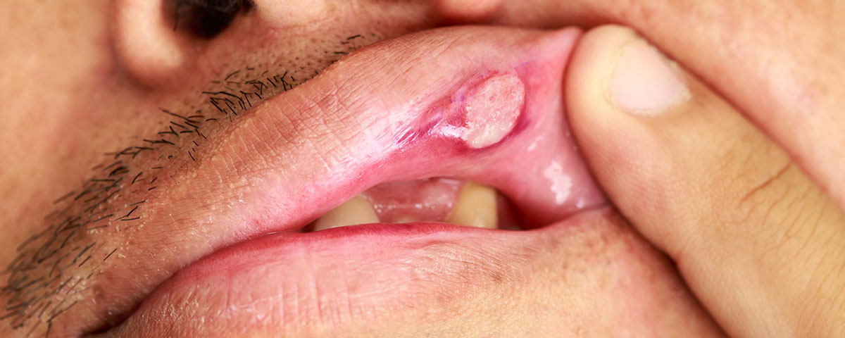 mouth ulcer under lips